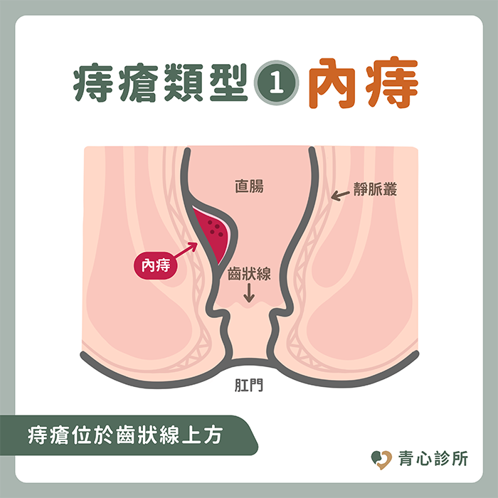 痔瘡分類 內痔 外痔 混合痔 齒狀線解剖示意圖 青心診所衛教