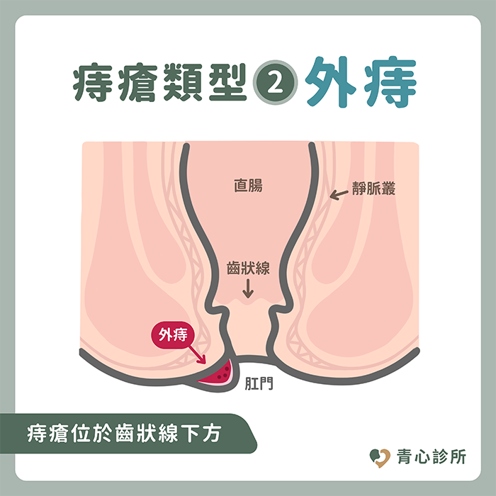 外痔瘡示意圖