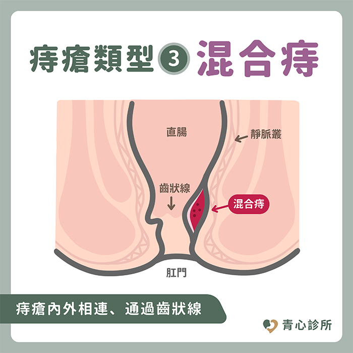 混合痔瘡示意圖