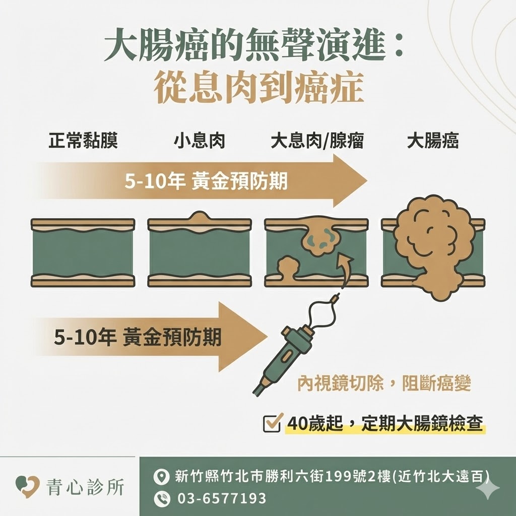 從息肉到癌症演變圖