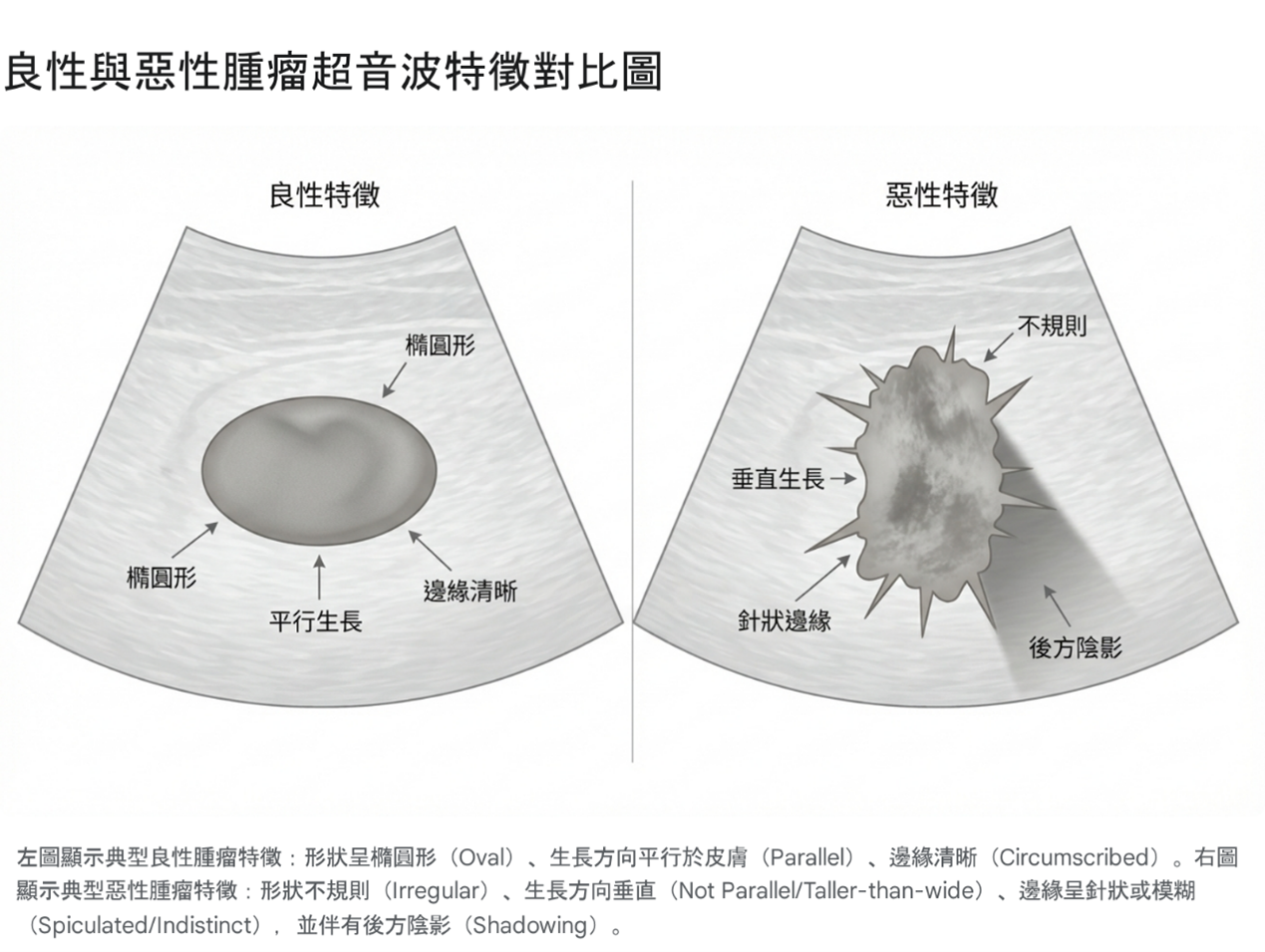 乳房超音波影像形狀特徵示意圖