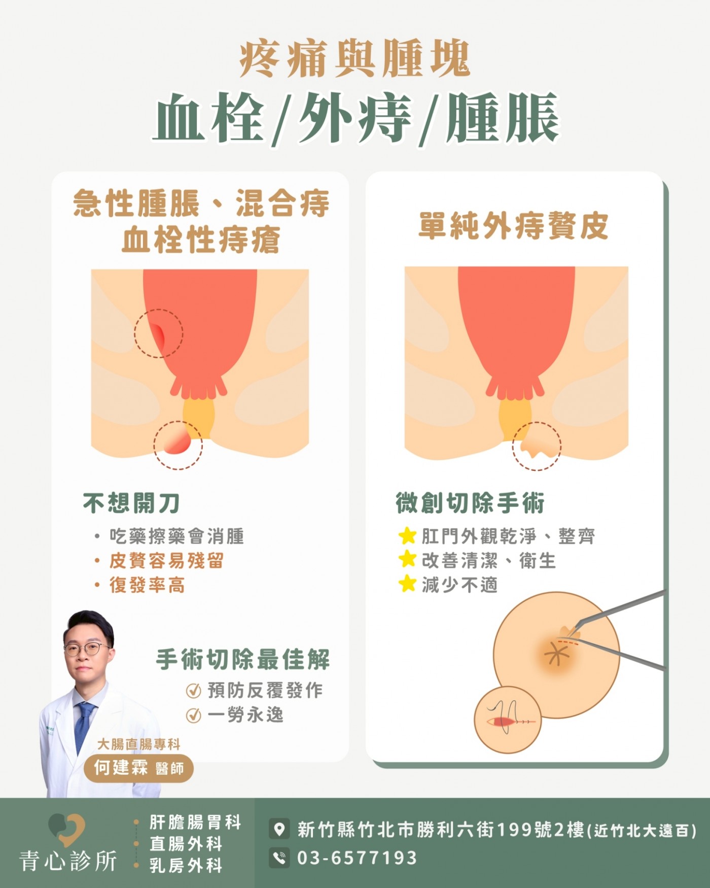 血栓性外痔與贅皮的微創治療解說
