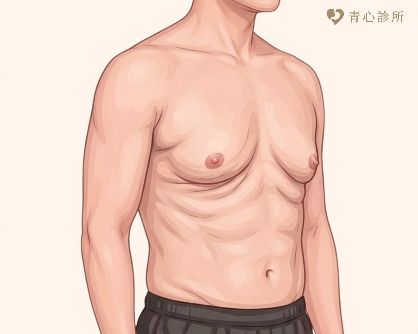男性女乳症分型說明圖片