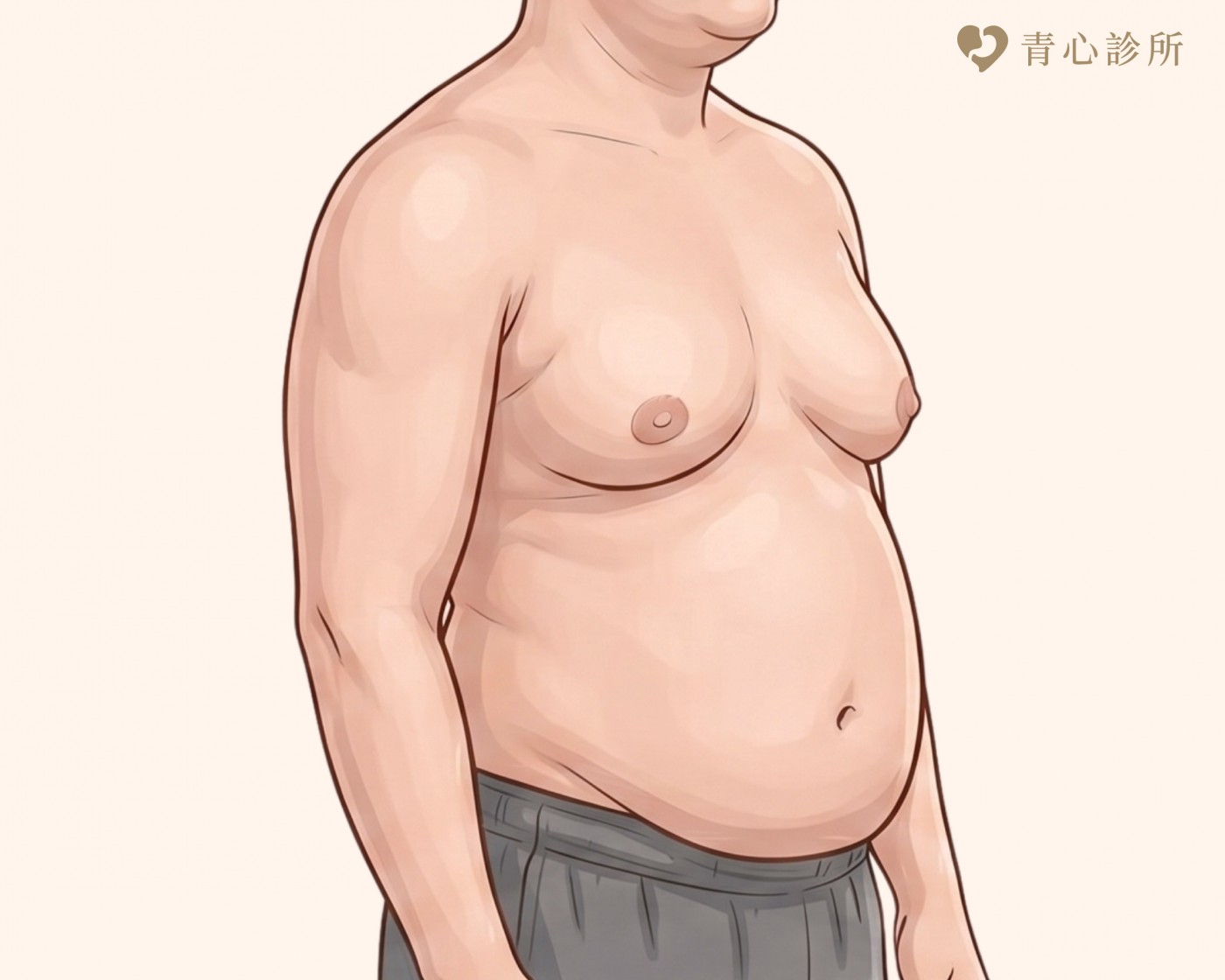 男性女乳症分型說明圖片