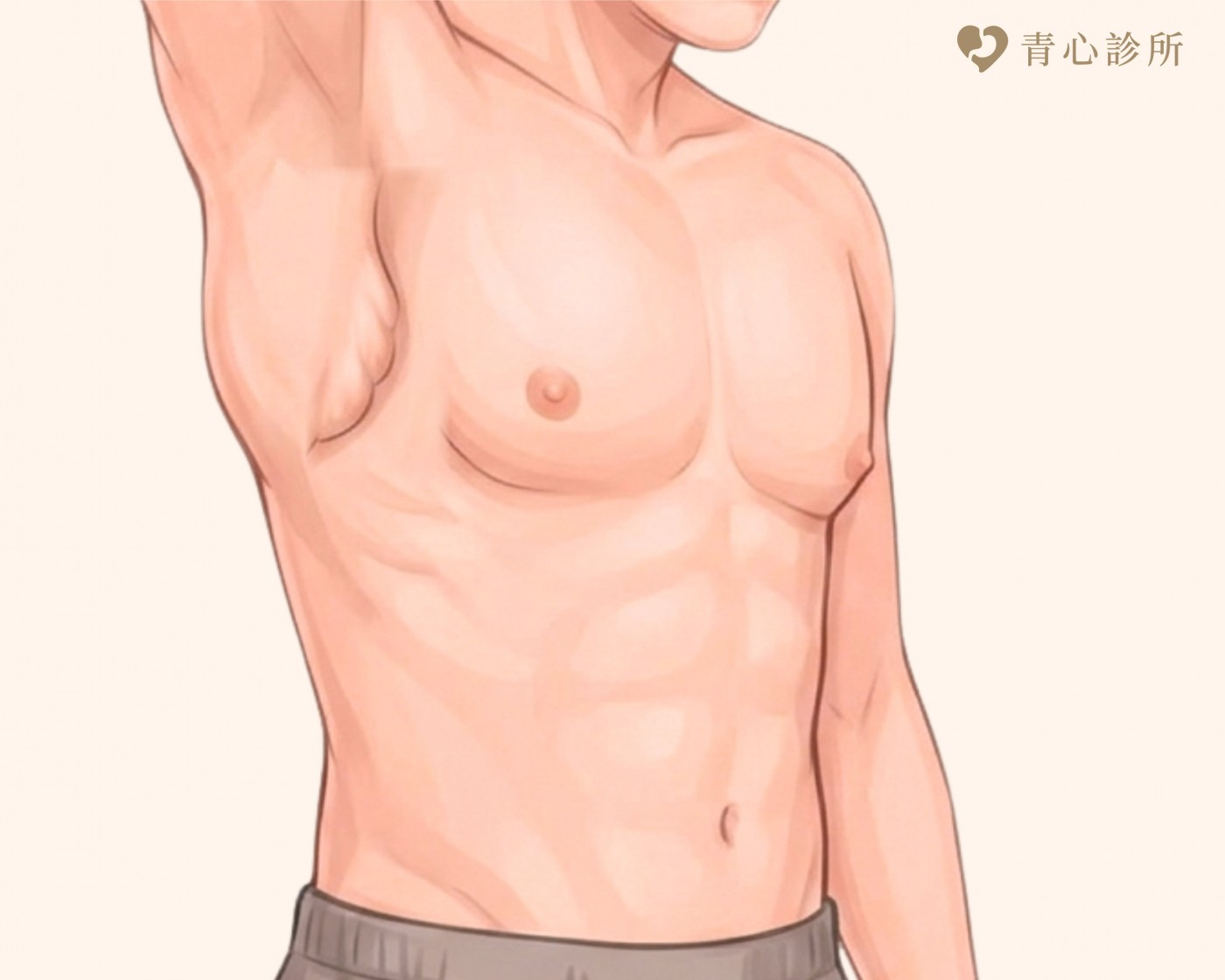男性女乳症分型說明圖片