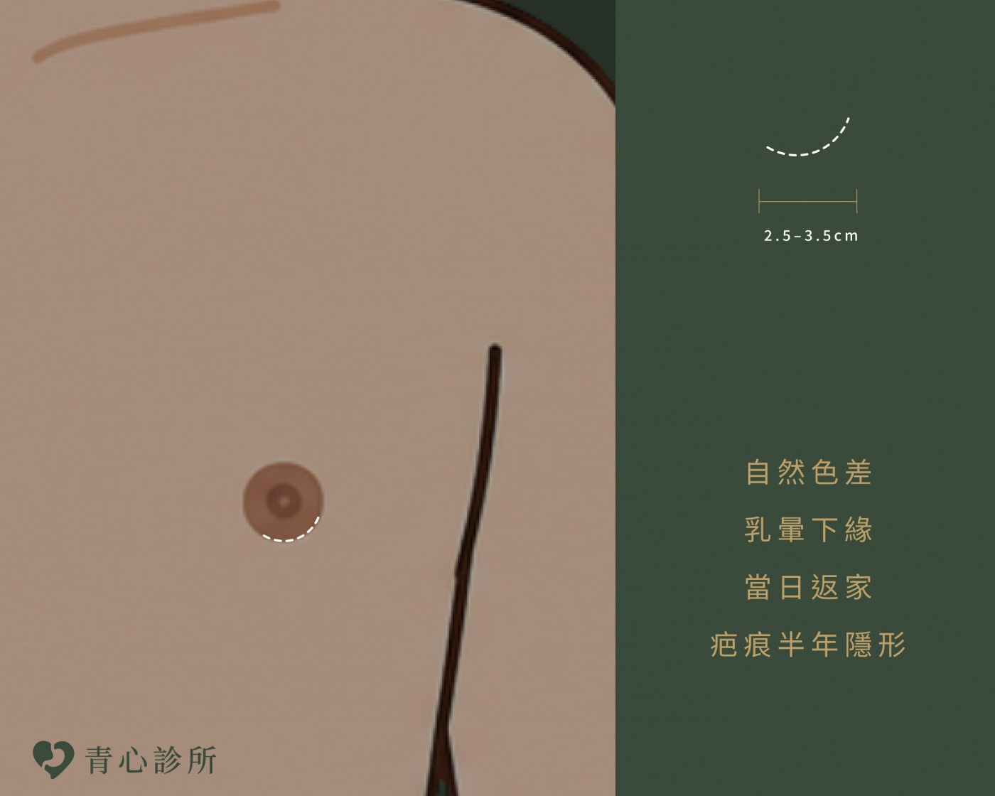 男性女乳症說明圖片
